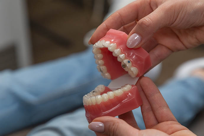 Invisalign